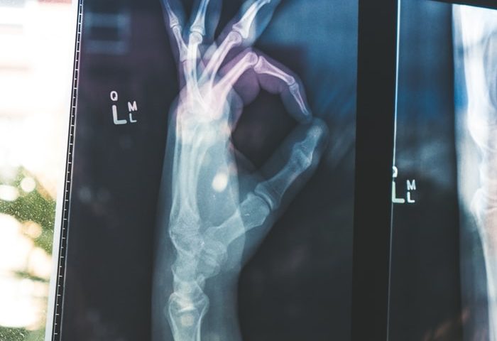FAQs About X-Rays